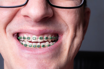 Braces and brackets on teeth, stamotology of medecine alignment of teeth orthodontist