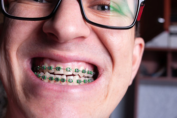 Braces and brackets on teeth, stamotology of medecine alignment of teeth orthodontist