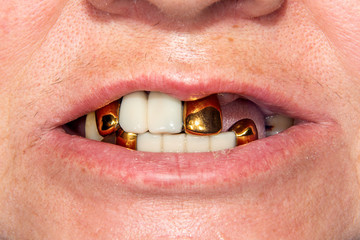 Patient with bad metal dental crowns close-up. The concept of treatment and restoration of...