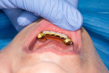 Patient with bad metal dental crowns close-up. The concept of treatment and restoration of...
