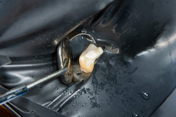 two chewing side teeth of the upper jaw after treatment of caries. Restoration of the chewing surface with a photopolymer filling material using the Rubber Dam system © Сергей Кучугурный