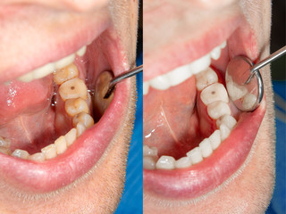 two chewing side teeth of the upper jaw after treatment of caries. Restoration of the chewing surface with a photopolymer filling material using the Rubber Dam system © Сергей Кучугурный