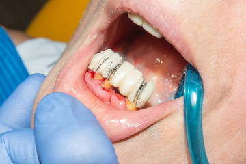 restoration of a rotten tooth decayed tooth close-up. The concept of therapeutic aesthetic...