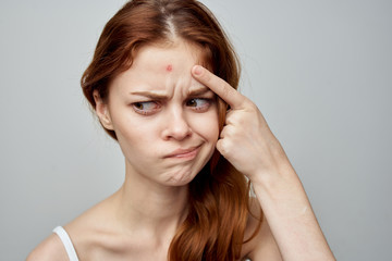 Fototapeta premium woman with acne on the forehead