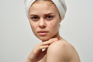 woman with a towel on her head acne on her face