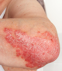 Detail of psoriatic skin disease on elbow Psoriasis Vulgaris with narrow focus, skin patches...
