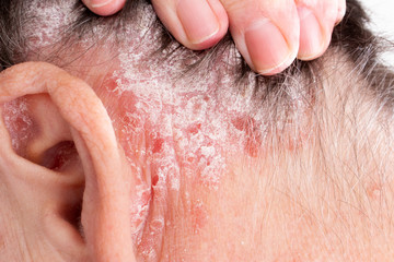 Detail of psoriatic skin disease Psoriasis Vulgaris in hair and ear with narrow focus, skin patches typically red itchy and scaly