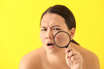 Portrait of young Asian woman with acne problem and magnifier on color background