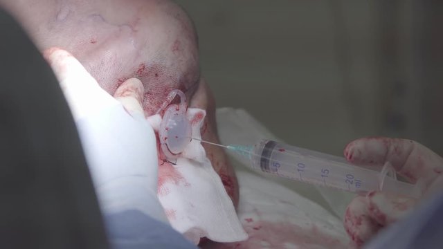 Surgeon fills up the tissue expander with saline using syringe, and push the   implant into the skin fold during the plastic surgery close-up (4K, 25fps)