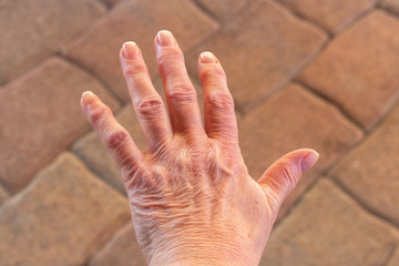 These are hands of a old woman with finger pain