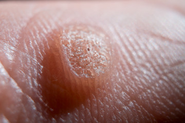 Verruca on hand. Warts or moles removing concept