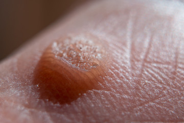 Verruca closeup, warts freezing concept