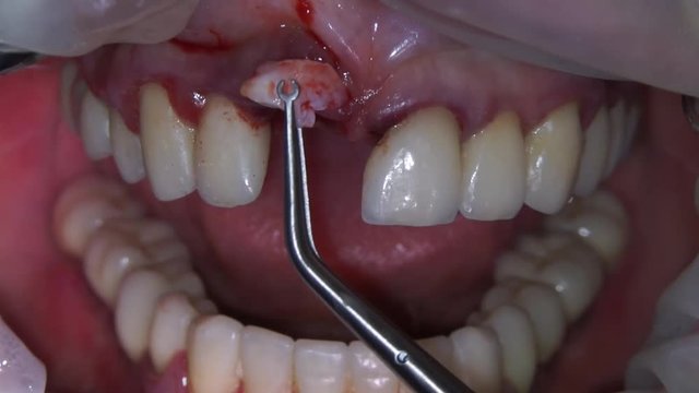 adding soft tissue to the gingival cavity and suturing tissue for recovery and aesthetics