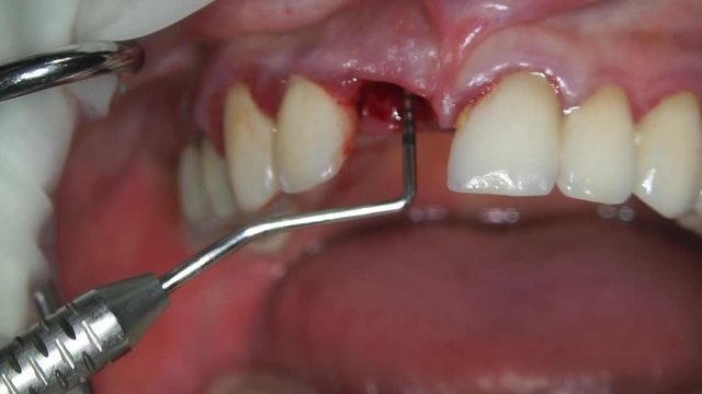 checking the depth of the gums after removing the front tooth incisor