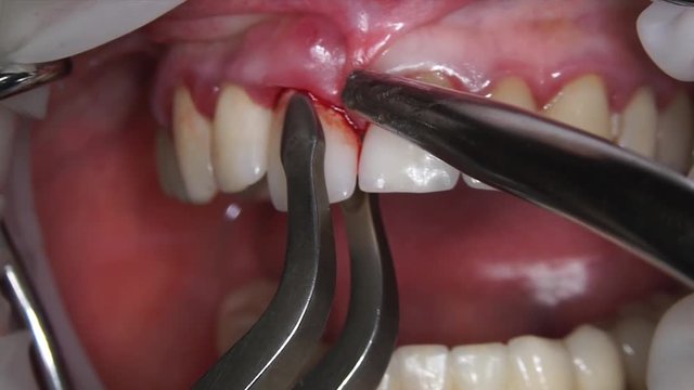 removal of the front tooth with carbonic root