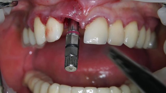 screwing up the dental implant with a special implant tube