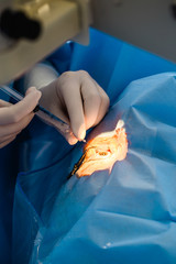 Eye surgery process, treatment of cataract and diopter correction. Surgical implementation of...