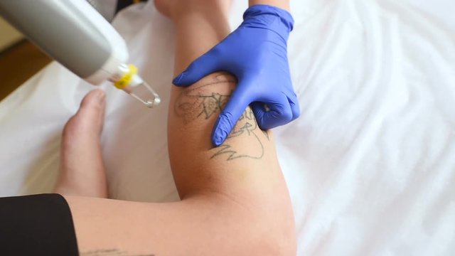 the cosmetologist removes the tattoo on the leg of a young pretty girl with a laser. Laser cosmetology
