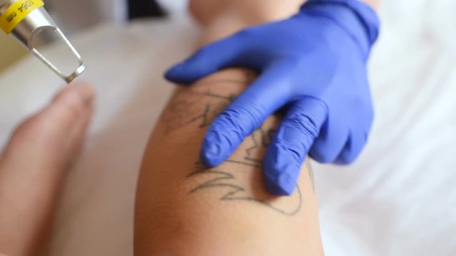 the cosmetologist removes the tattoo on the leg of a young pretty girl with a laser. Laser cosmetology