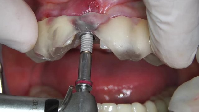 drilling with long surgical bits.before dental implantation