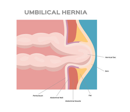 Umbilical Hernia / Intestine / Human Anatomy / Belly Vector