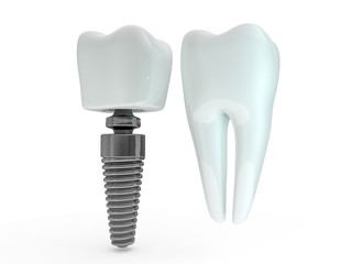 Dental implant dentist, tooth layout, plastics, man, teeth, treatment. 3D - obrazy, fototapety, plakaty