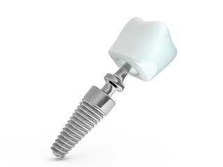 Dental implant dentist, tooth layout, plastics, man, teeth, treatment. 3D