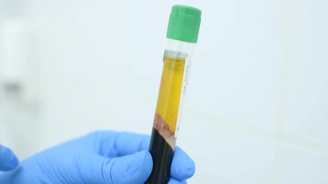 plasma extraction from the patient's blood for the procedure of plasmolifting-skin rejuvenation.