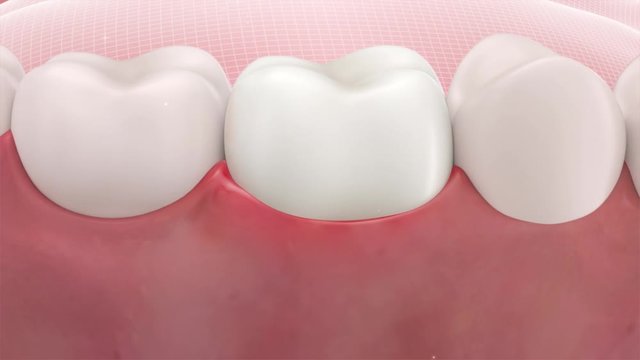 Teeth and gum healing 