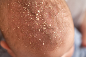 Fototapeta premium Seborrheic dermatitis on head in asian baby