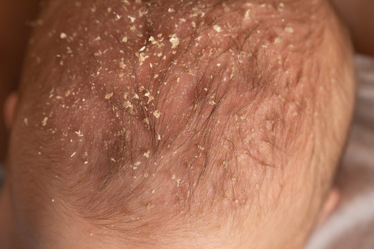 Seborrheic Dermatitis On Head In Asian Baby