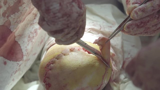 Surgeon cuts the excess skin sewing the stump after the shin amputation   surgery (close-up, 4K, 25fps)