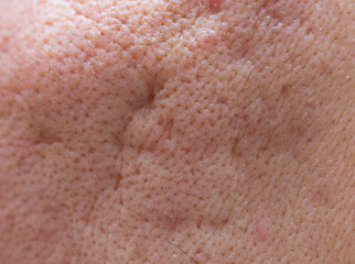 Acne skin on face woman,problem skin. macro