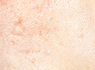 Acne skin on face woman,problem skin. macro
