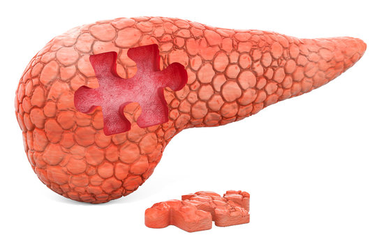 Pancreatic disease, medical concept, 3D rendering