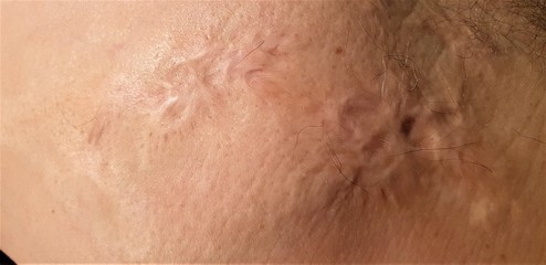 Fototapeta premium Burns on the human body.Scar from burns on the body. Wounds on the body.