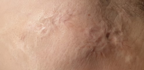 Fototapeta premium Burns on the human body.Scar from burns on the body. Wounds on the body.