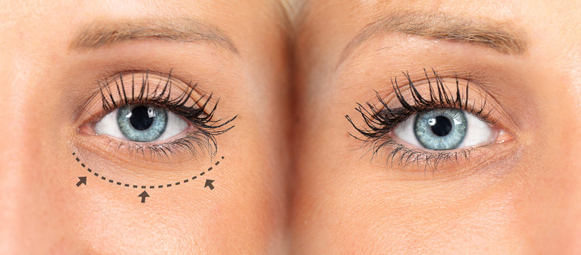 Woman eyes before and after bleparoplasty