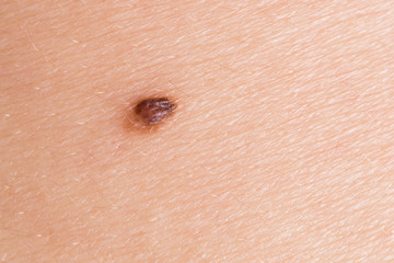 Abnormal mole