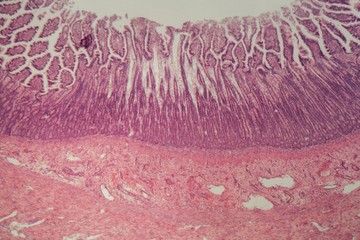 Microscope photo of a large intestine section with inflammation (Colitis).