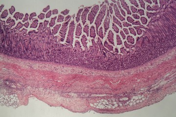 Microscope photo of a large intestine section with inflammation (Colitis).