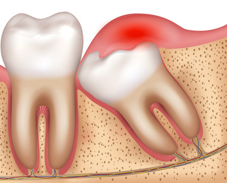 Wisdom tooth eruption problems inflamed gums illustrated anatomy