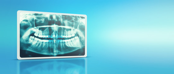 Woman x-ray of the teeth wisdom teeth horizontal pozition problem dentistry medicine. Panoramic...
