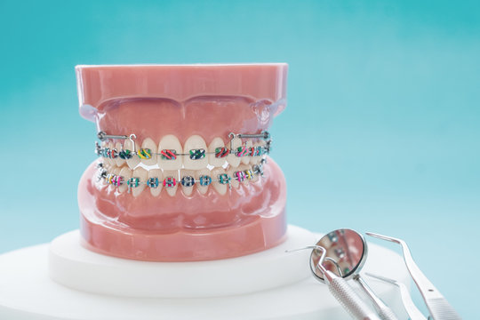 orthodontic model and dentist tool - demonstration teeth model of varities of orthodontic bracket or brace
