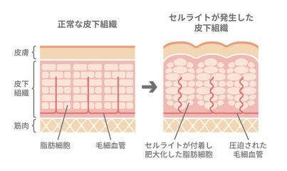 健康な皮膚とセルライトが発生した皮膚の断面比較イラスト