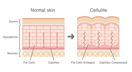 Comparative illustration of normal skin and cellulite's skin  - obrazy, fototapety, plakaty