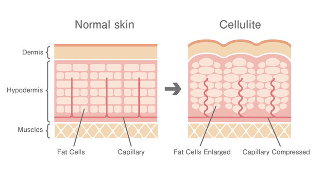 Comparative illustration of normal skin and cellulite's skin 
