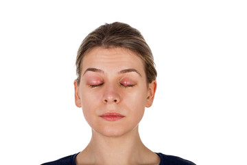 Chalazion - Eyelid infection