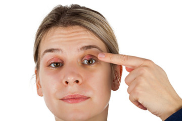 Chalazion - Eyelid infection