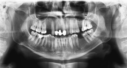 Panoramic radiograph is a panoramic scanning dental X-ray of the upper and lower jaw. This is a focal plane tomography shows the maxilla and mandible of a forty year old man.